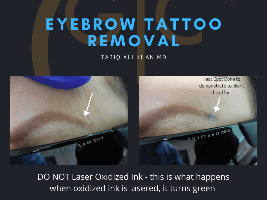 GCL Before and After picture - Eyebrow Tattoo Removal oxidized ink